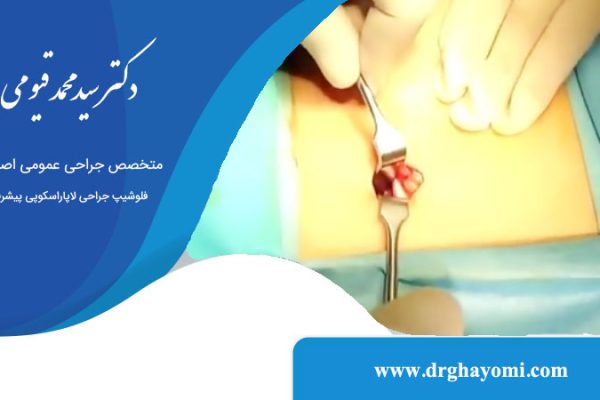 همه چیز راجع به جراحی آپاندیس