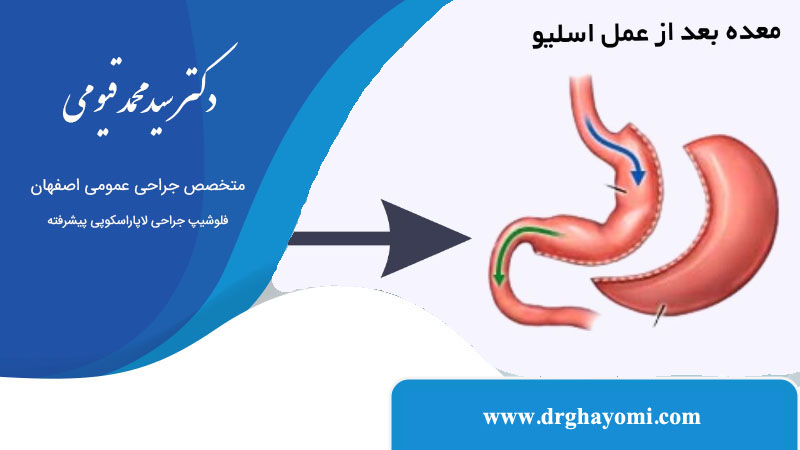 هزینه عمل اسلیو معده