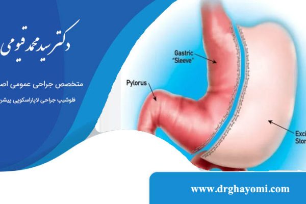 ایا عمل اسلیو معده بازگشت دارد؟