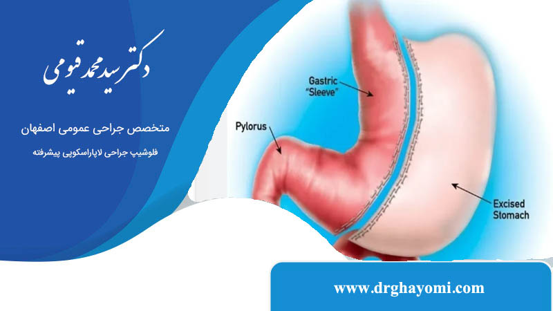 ایا عمل اسلیو معده بازگشت دارد؟