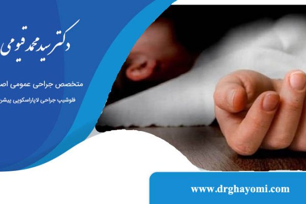 ایا اسلیو معده باعث مرگ میشود؟