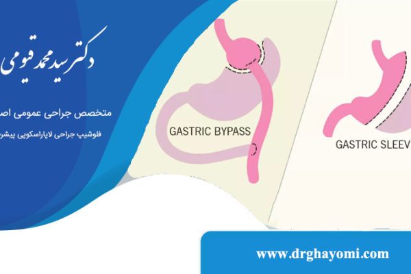 تفاوت اسلیو معده و بای پس