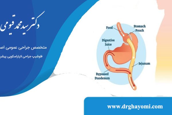 جراحی بای پس معده