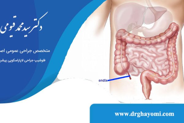 آپاندیس چیست
