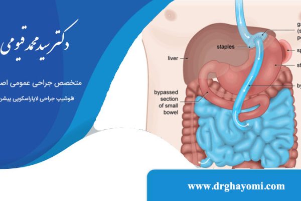 آیا عمل بای پس معده باعث سرطان می شود