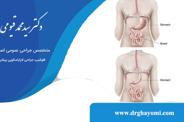 بای پس معده با لاپاراسکوپی