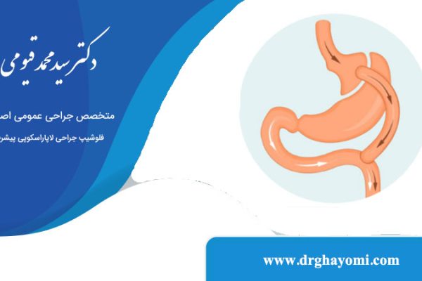 بای پس معده چیست