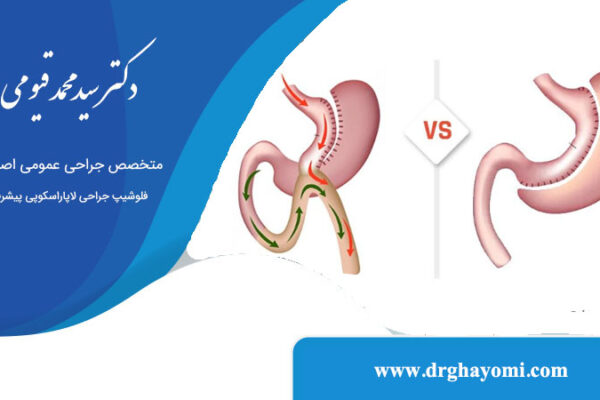 تفاوت اسلیو و بای پس معده