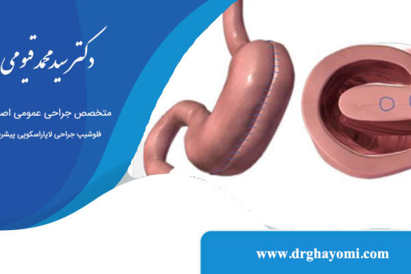 جراحی پلیکاسیون معده