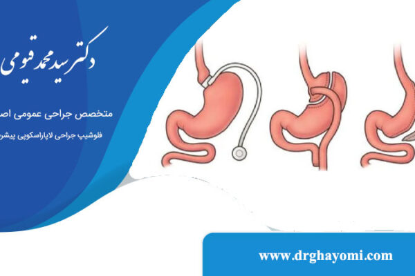 جراحی معده برای کاهش وزن