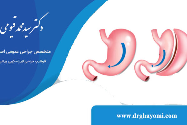 چند درصد از معده در عمل اسلیو برداشته میشود