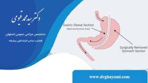 عمل اسلیو معده چیست