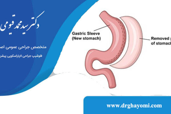 عمل اسلیو ساسی معده