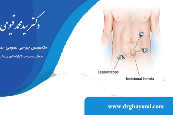 جراحی فتق با لاپاراسکوپی