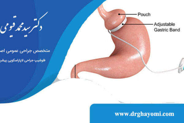 عمل باندینگ معده