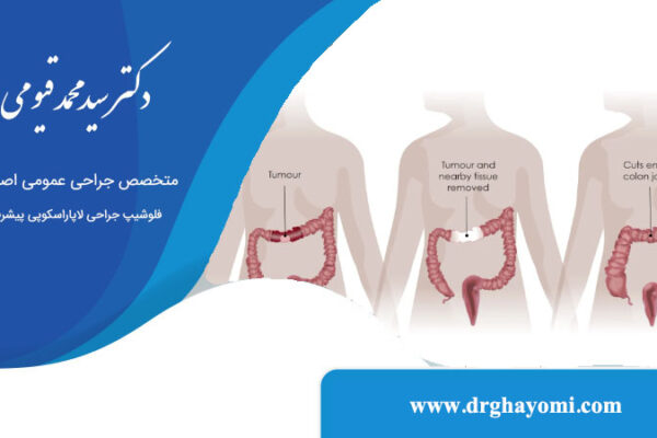 مراحل جراحی سرطان کولون