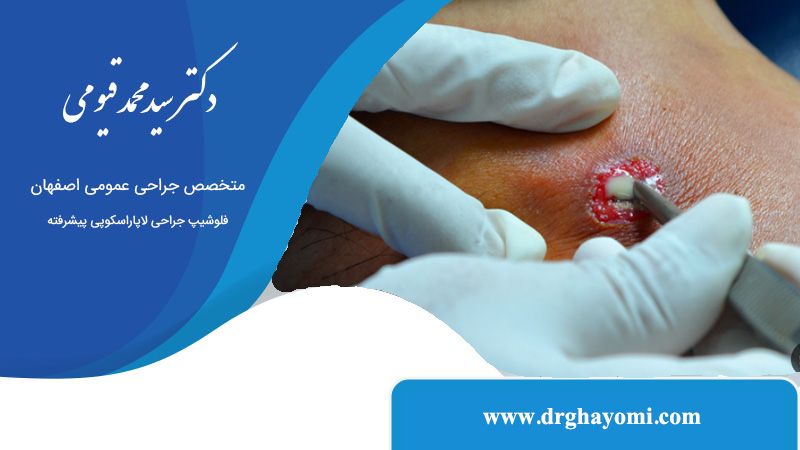 نقش جراح عمومی در درمان آبسه‌ های بدن