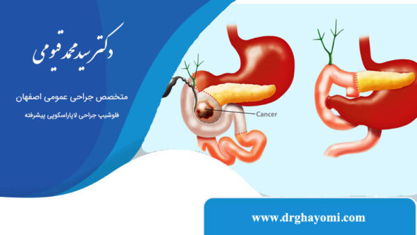 عمل Whipple برای درمان سرطان لوزالمعده
