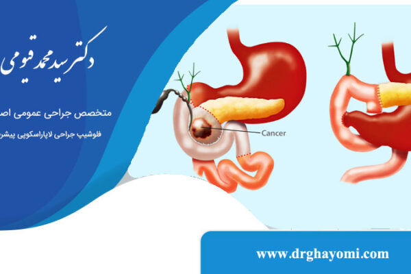 عمل Whipple برای درمان سرطان لوزالمعده