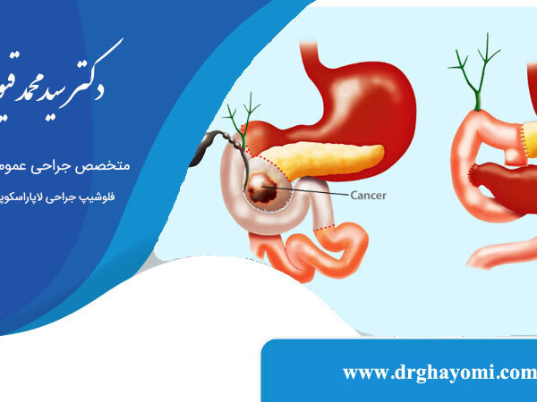 عمل Whipple برای درمان سرطان لوزالمعده