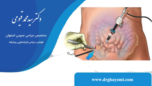 لاپاراسکوپی برای درمان اندومتریوز