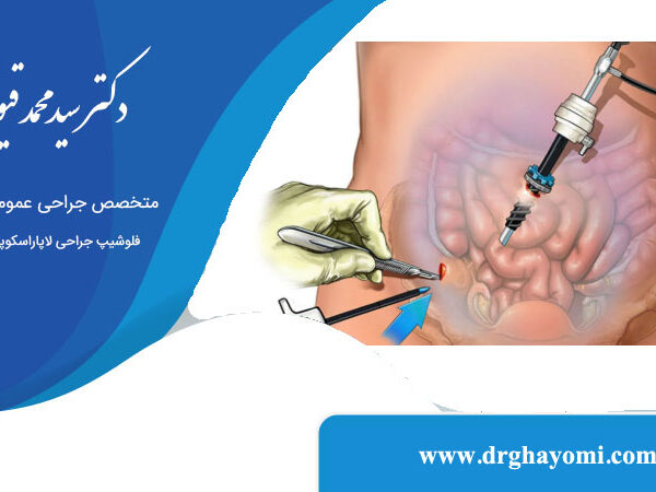 لاپاراسکوپی برای درمان اندومتریوز