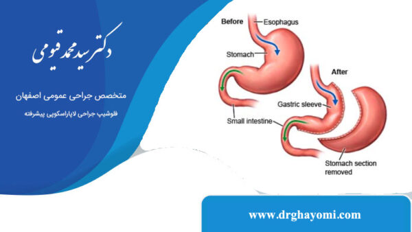 تفاوت اسلیو استاندارد و ساسی