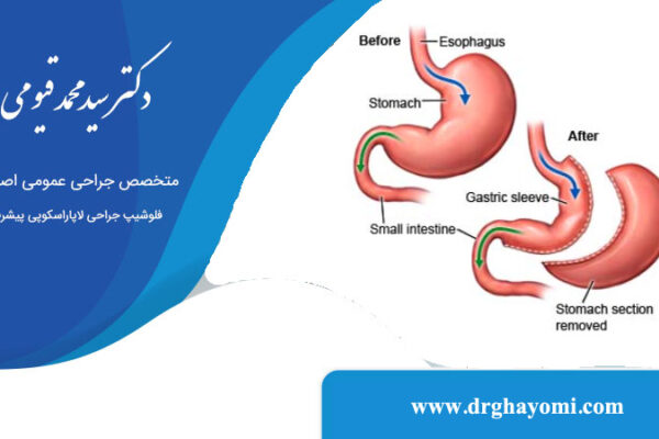 تفاوت اسلیو استاندارد و ساسی