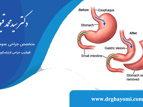 تفاوت اسلیو استاندارد و ساسی
