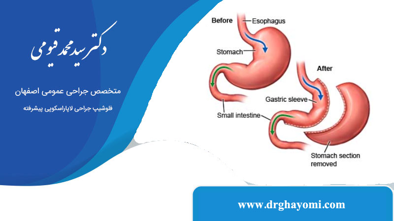تفاوت اسلیو استاندارد و ساسی