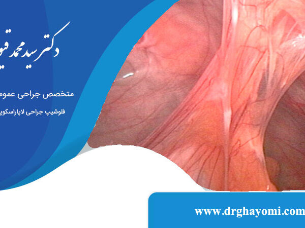 تشخیص چسبندگی شکم با لاپاراسکوپی