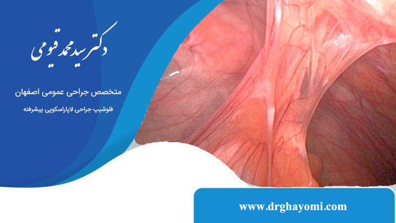 تشخیص چسبندگی شکم با لاپاراسکوپی