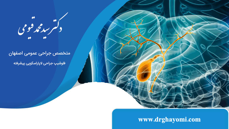 ارتباط سنگ صفرا با چاقی