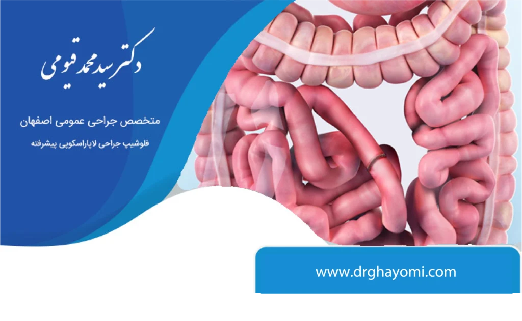 کاهش خطر ابتلا به سرطان روده