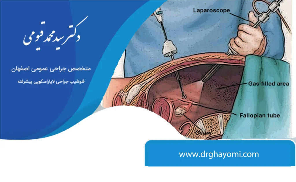 جراحی لاپاراسکوپی و مزایا