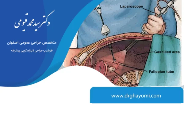 جراحی لاپاراسکوپی و مزایا
