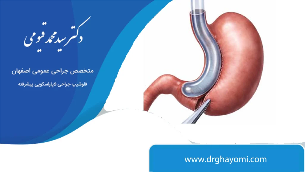 عوارض اسلیو معده