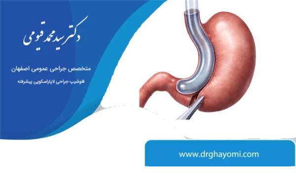 عوارض اسلیو معده