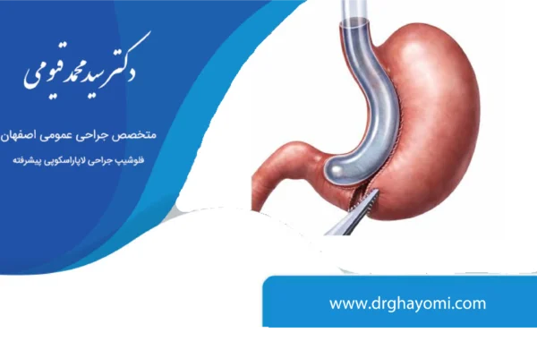 عوارض اسلیو معده
