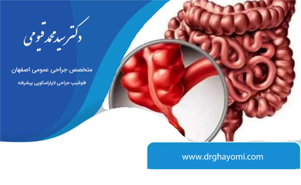همیشگی جراحی آپاندیس
