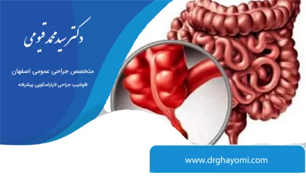 همیشگی جراحی آپاندیس