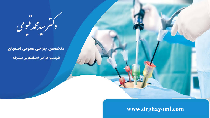 لاپاراسکوپی