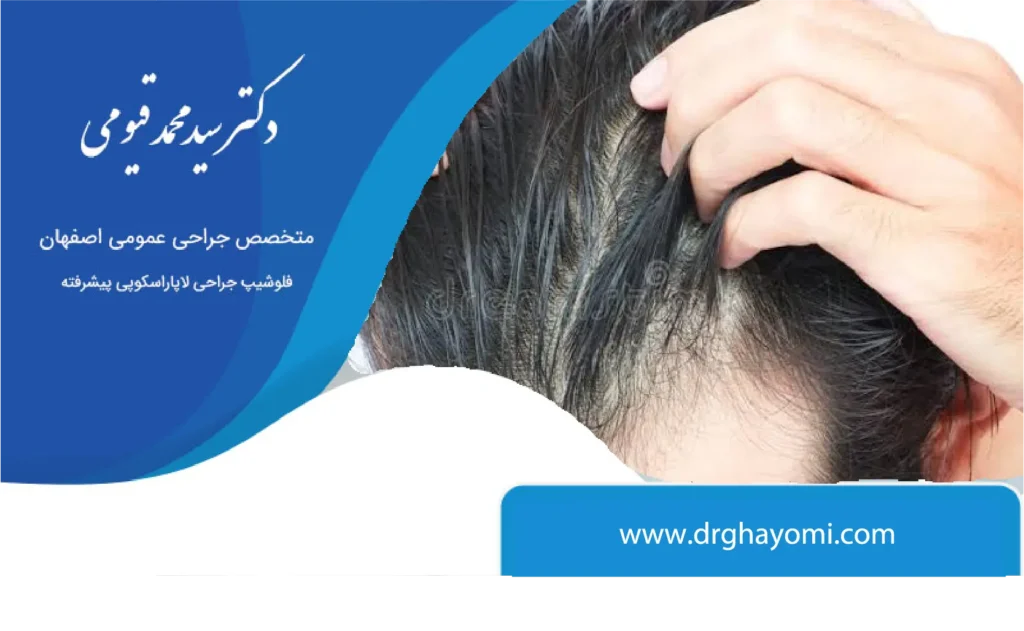 ریزش مو بعداز اسلیو