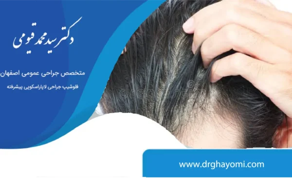 ریزش مو بعداز اسلیو